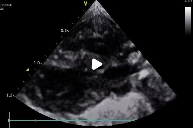 Ecocardiograma de un paciente erizo